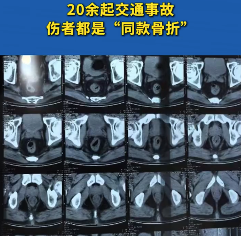 3个月做20多次CT 16人自导自演被撞骨折骗保30余万