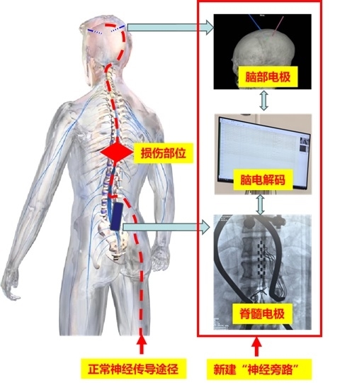 完全截癱患者在上海走起來(lái)了 腦脊接口技術(shù)創(chuàng)奇跡