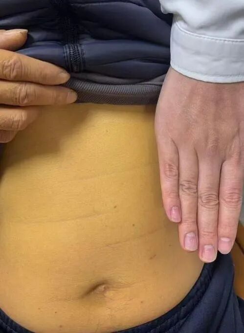 须眉得漠视病腹痛10年全身变黄 忽视小痛酿大祸