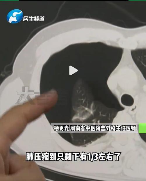 男子减肥做20个俯卧撑肺炸了 剧烈运动致气胸