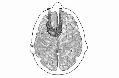 新技术有望治疗癫痫等脑病