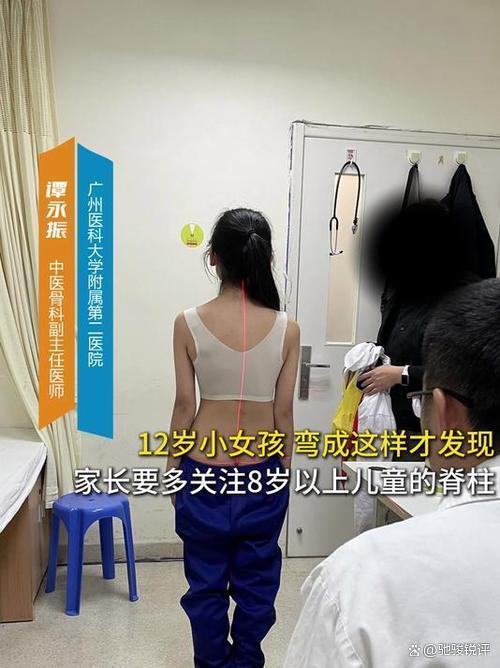 12岁患重度脊柱侧弯 全民科普亟待加强