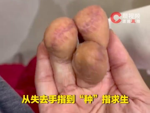 女子手指截肢放肚里养1个月变小肉球 