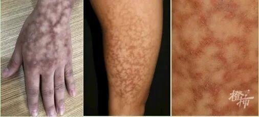 一覺睡醒長出“蟒蛇紋”、水皰！冬季警惕這類燙傷