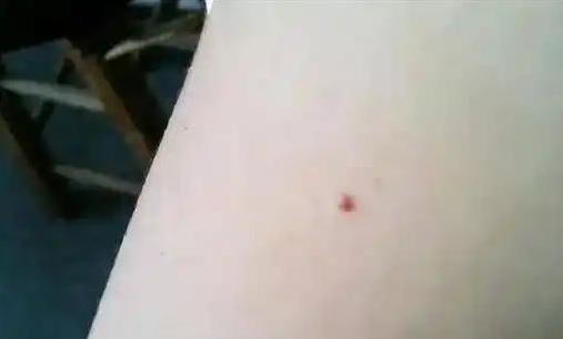 身上红痣猛增有隐患？医生揭秘真相，3点建议别忽视