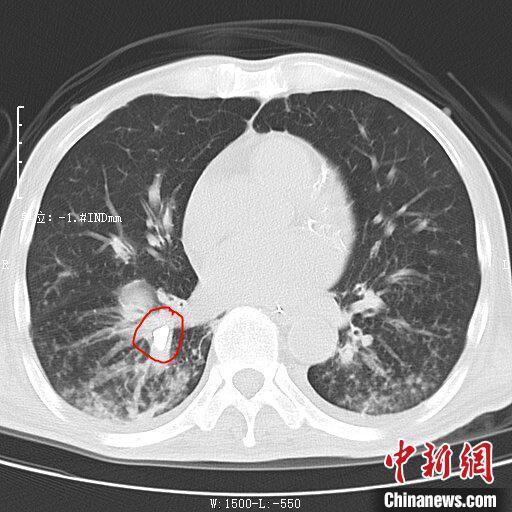 男子反复发热查出肺里有颗牙齿 异物成功取出转危为安