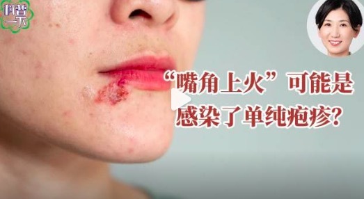 嘴角上火可能是感染了單純皰疹？一旦感染如何應(yīng)對(duì)