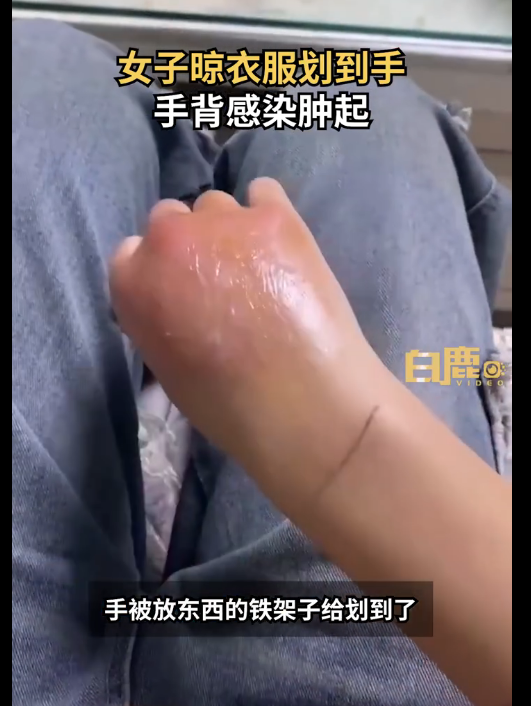 女子手被铁架划伤未在意次日肿成球