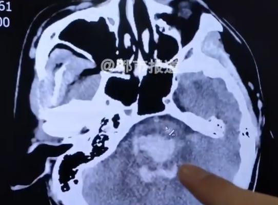 男子吵架猝死邻居担责赔偿 情绪激动引悲剧
