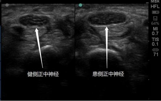 新规发布：伤不起的“鼠标手”也算职业病啦 腕管综合征纳入目录