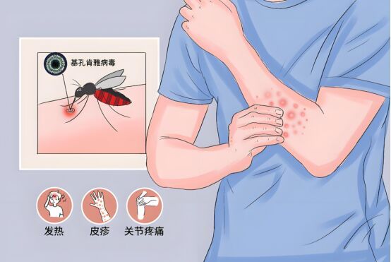 基孔肯雅熱與登革熱有啥不同 癥狀相似易混淆