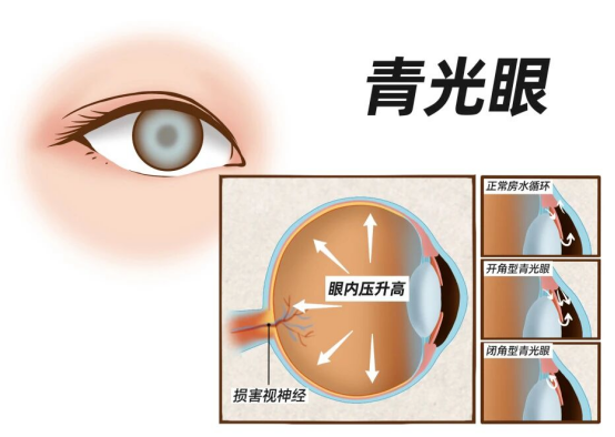 青光眼是老年人专利？系误解