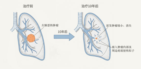 65岁爷爷患肺癌晚期存活10年 精准治疗创奇迹