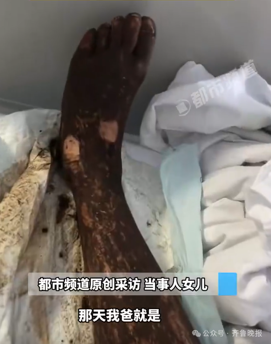 男子走路玩手机踩中打架的竹叶青五步蛇！被咬3口