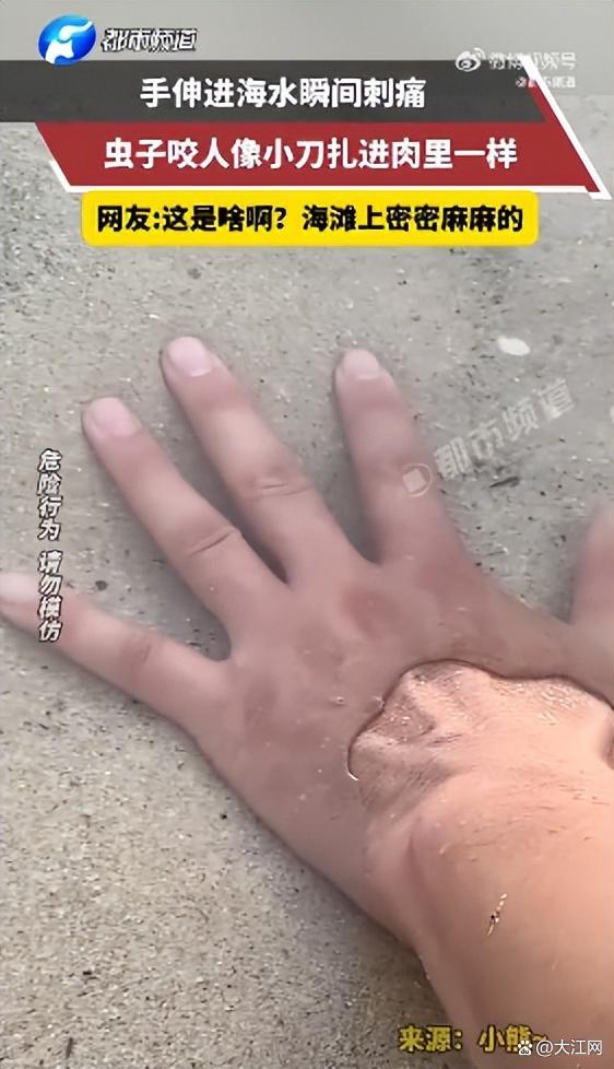 男子手入海水被芝麻大小虫咬如刀扎
