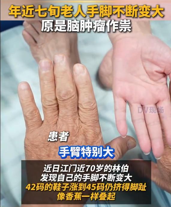 老人年近七旬手脚还在长大 罕见疾病信号