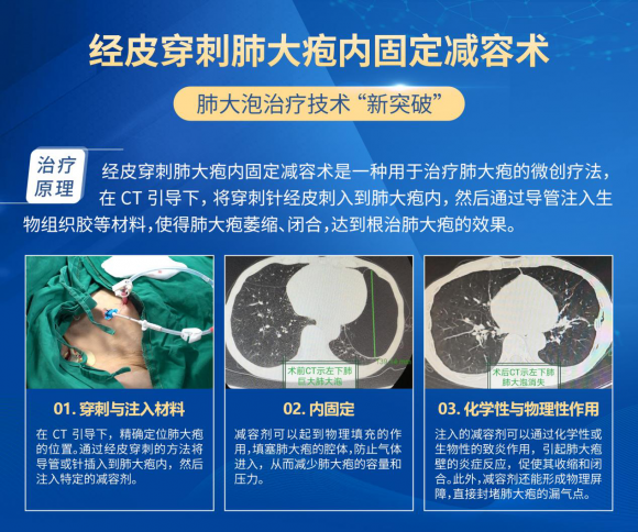 一针减容重塑肺活力：芮军主任解析经皮穿刺肺大疱内固定减容术优势