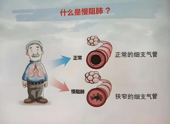 郑继红老中医中西医结合新方案：突破慢阻肺治疗瓶颈