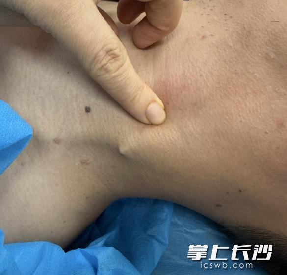 男子硬吞饭团把鱼刺扎进颈部皮下