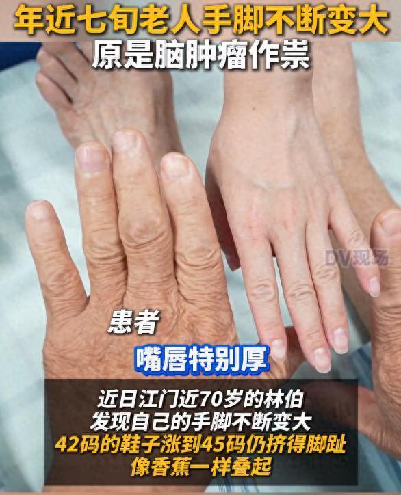 七旬老人手脚变大原是脑肿瘤作祟 医生提醒：看似平常的身体变化，可能是疾病发出的“求救信号”