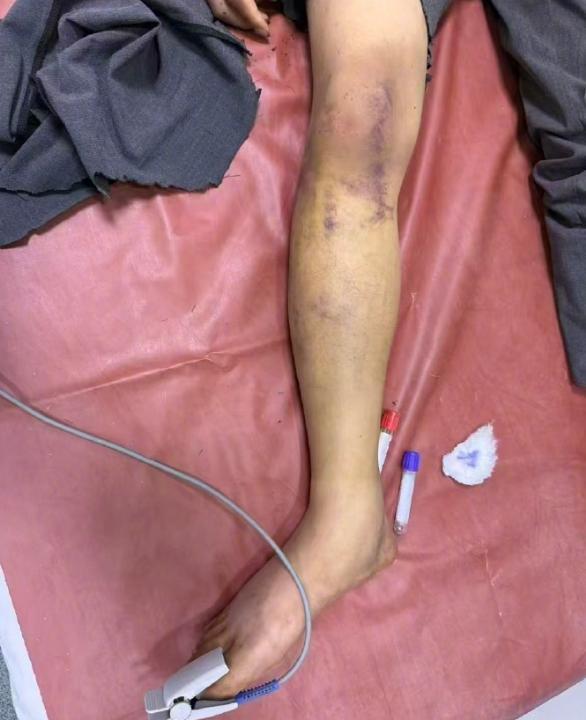 網(wǎng)紅回應(yīng)在非洲遭同胞綁架虐待7天 勇敢逃脫求助當(dāng)?shù)孛癖?></p><p class=