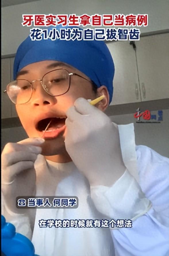 牙医实习生挑战为自己拔智齿 网友调侃“是个狠人！”
