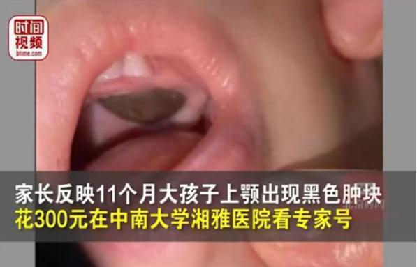 湘雅医院专家将莲子壳诊断为肿瘤 院方回应