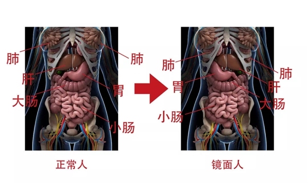 一女子五脏六腑全部反着长！发病率约为百万分之一