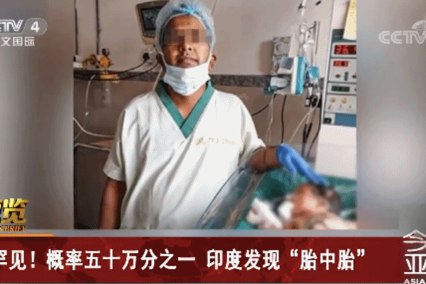 3周大女婴肚子里取出8个寄生胎：发病率五十万分之一