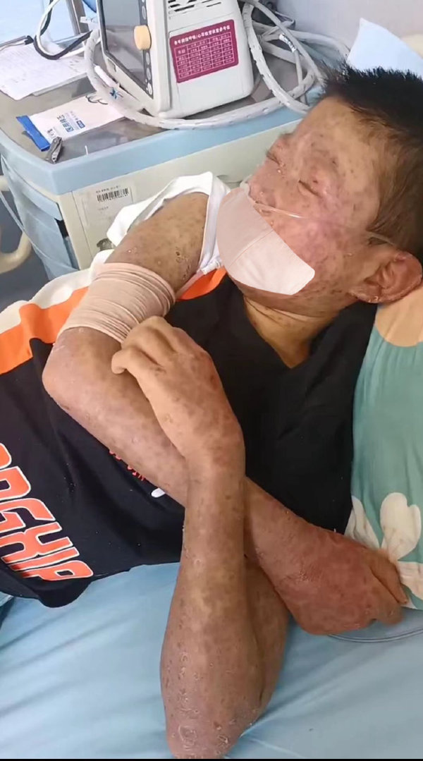 ​13岁男孩患怪病皮肤发黑浑身奇痒：原发性免疫缺陷