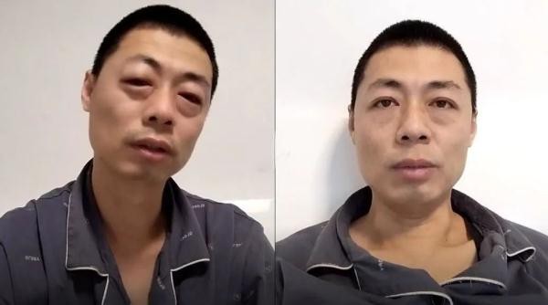 女子阳性后头发一夜变白