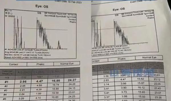 1岁婴儿被查出近视600度 原因竟在父母身上