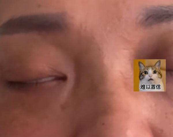 女子花3千元割眼袋致眼睛闭不合 一洗脸就进水难受得都想抠眼珠子