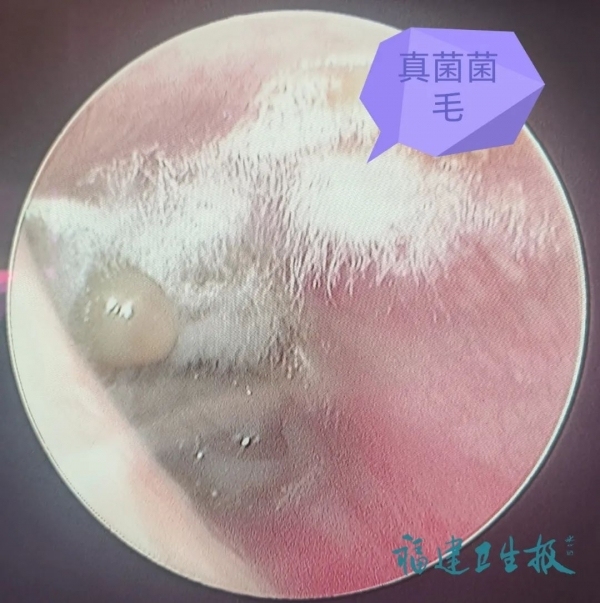 女子耳朵里长“脚气” 医生提醒：平时尽量少掏耳朵