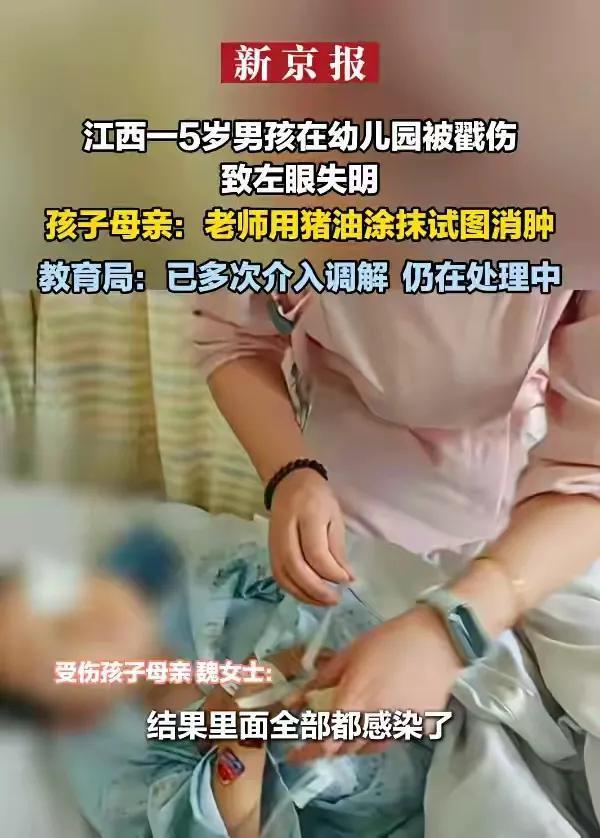 男孩幼儿园眼睛被戳伤诚实涂猪油消肿 母亲合计诚实未实时送医