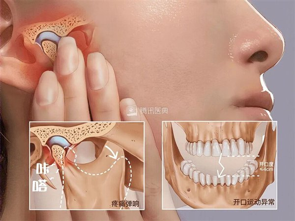 00后女子因浮躁磨牙患上TMD
