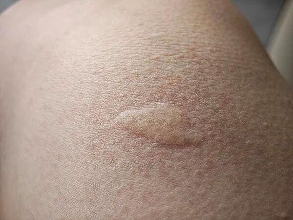 今年蚊子大军战力升级已提前杀到 加强版蚊子来袭