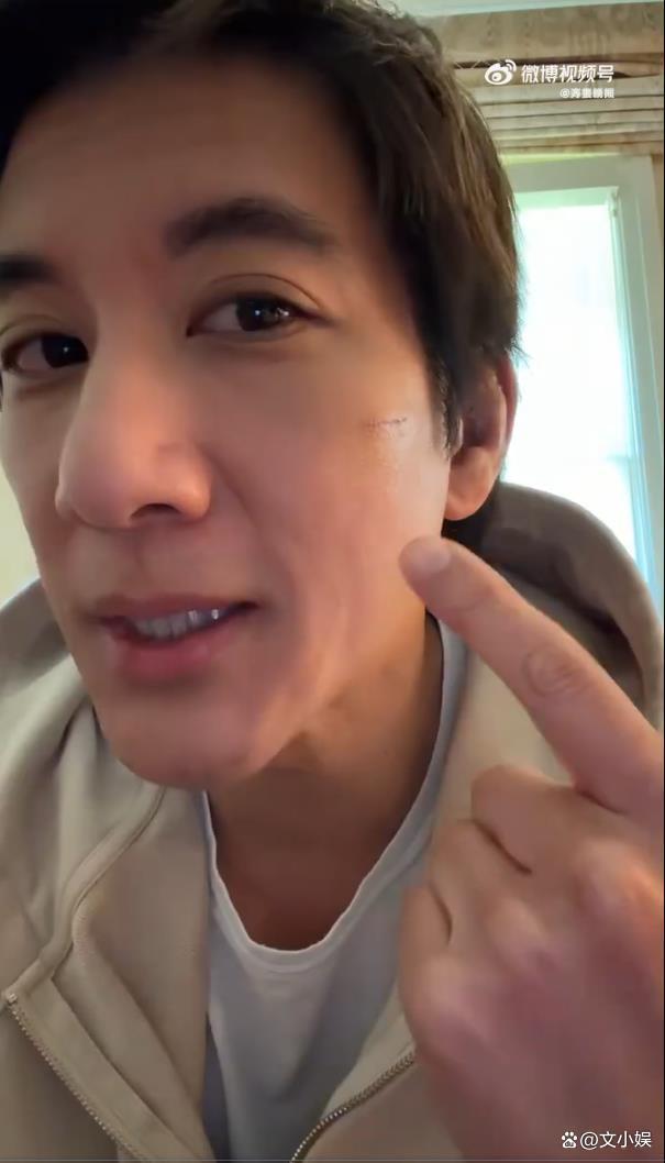 王力宏晒受伤后伤口恢复状况 预计明日拆线