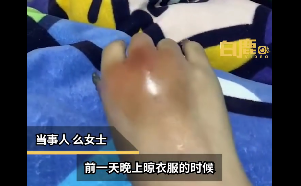 女子手被铁架划伤未在意次日肿成球