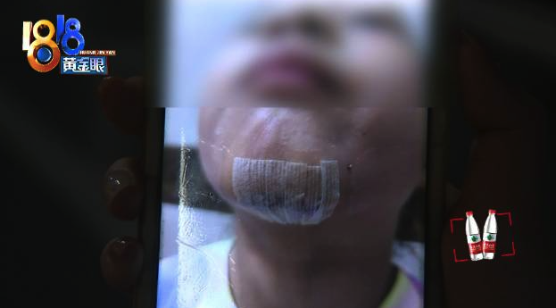 家长称女儿在湿滑地库摔伤缝针 物业：人道主义给1万