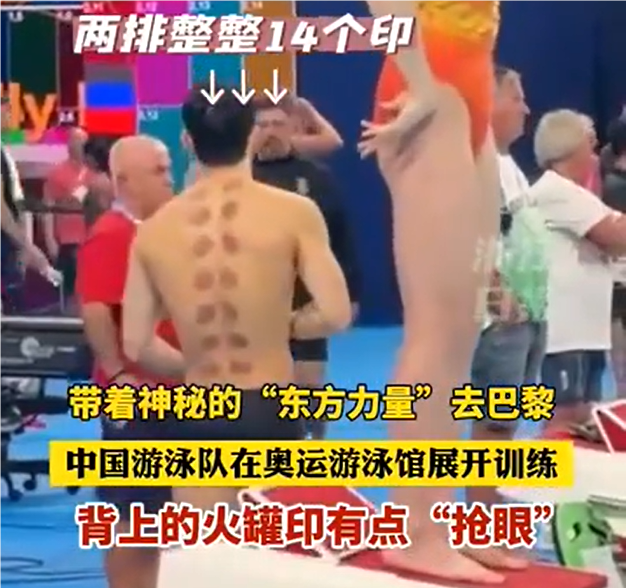中国游泳队身上全是火罐印 感受下神秘的东方力量