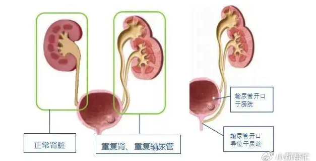 2个月女婴小便增多一查竟有4个肾