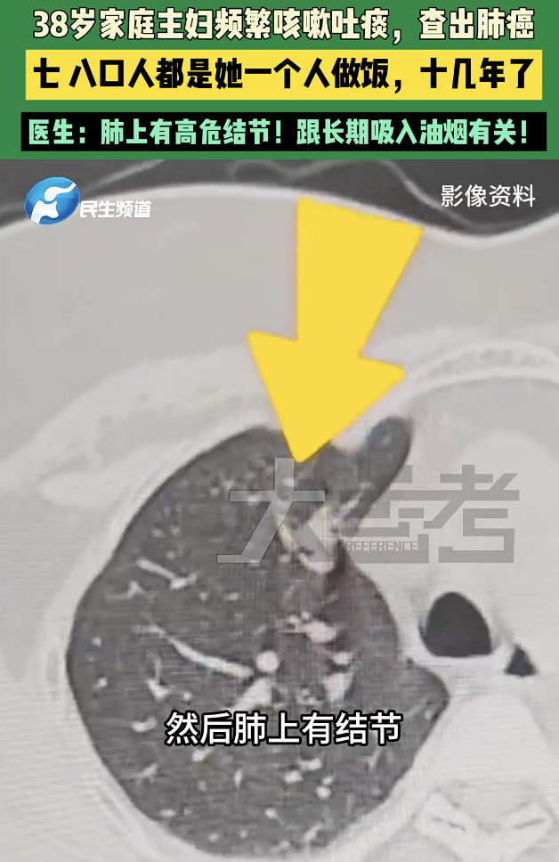 38岁女子频繁咳嗽吐痰查出肺癌