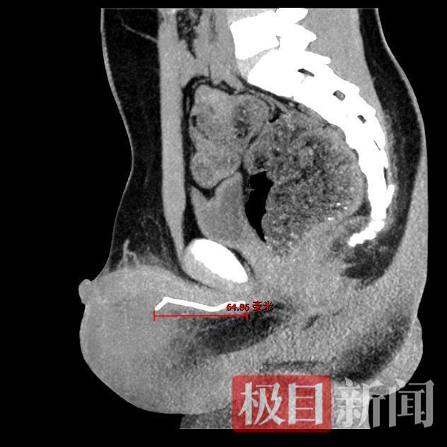 男孩將鐵絲塞進(jìn)尿道憋80多天 醫(yī)生微創(chuàng)手術(shù)成功取出7厘米異物