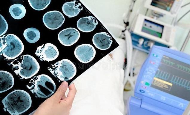 为何中国脑梗越来越多，美国却在减少？医生：主要原因有3点
