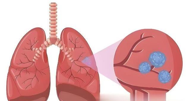 体检报告里的“结节”到底要不要切？科学解读来了