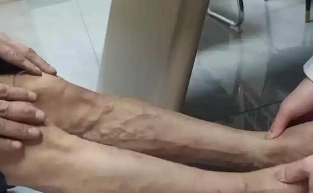 手背青筋鼓得吓人，查出血压高，3个地方青筋要当心