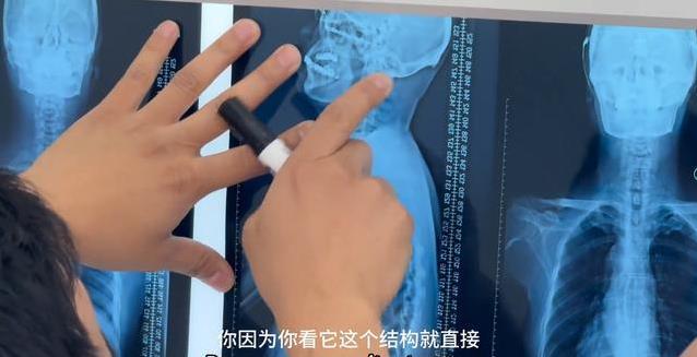 60岁大爷腰痛求正骨，医生看片吓一跳，脖子竟藏大问题