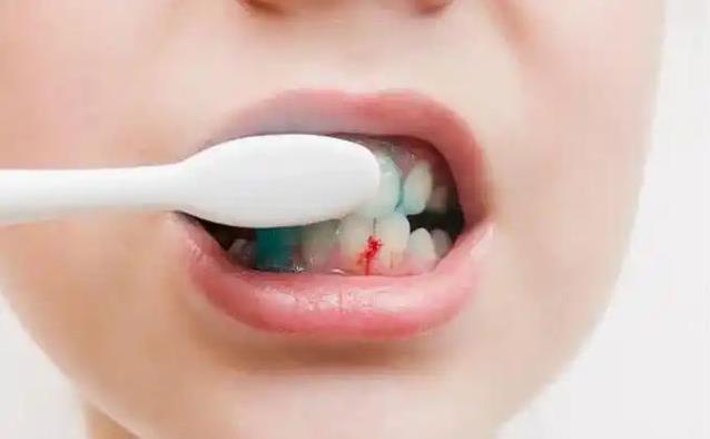 16岁少年牙龈出血查出白血病，4种牙齿异常信号，你家有吗？