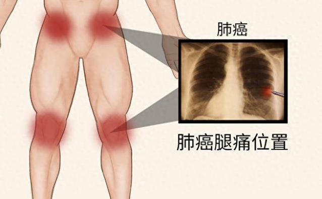 咳嗽三月腿痛难忍，查出肺癌晚期，骨头已被侵蚀